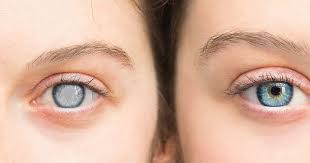 Ophthalmology