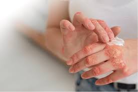 Skin Disease