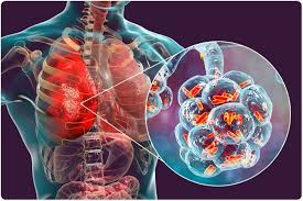Respiratory
