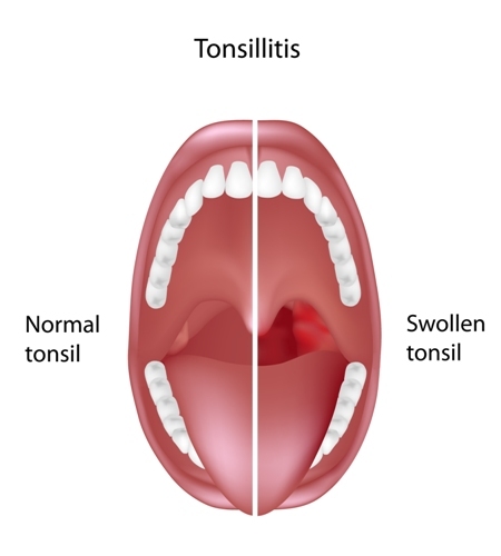 Tonsils