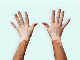 Skin Disease