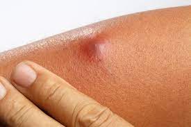 Skin Disease