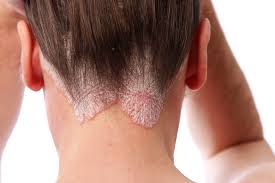 Skin Disease