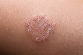 Skin Disease