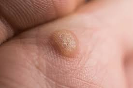 Skin Disease